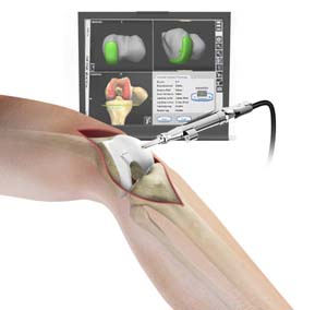 Computer Navigation for Total Knee Replacement pic