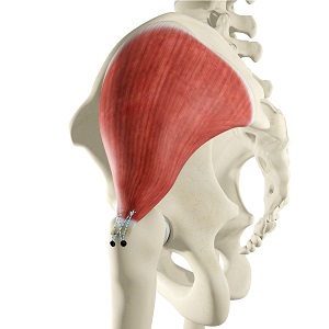 Open Gluteus Medius Repair pic