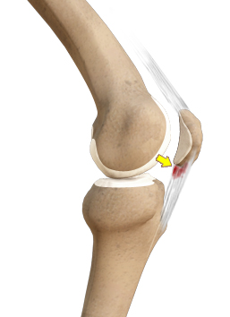 Patellar Tendinitis pic