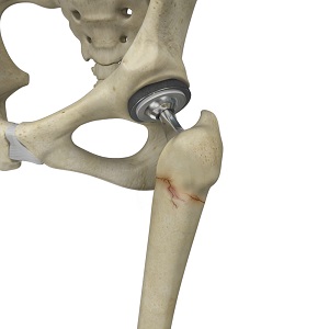 Periprosthetic Hip Fractures pic