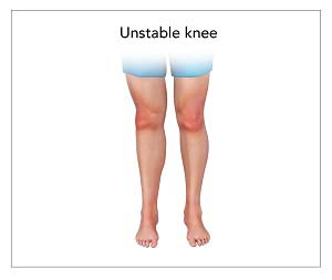 Unstable Knee pic