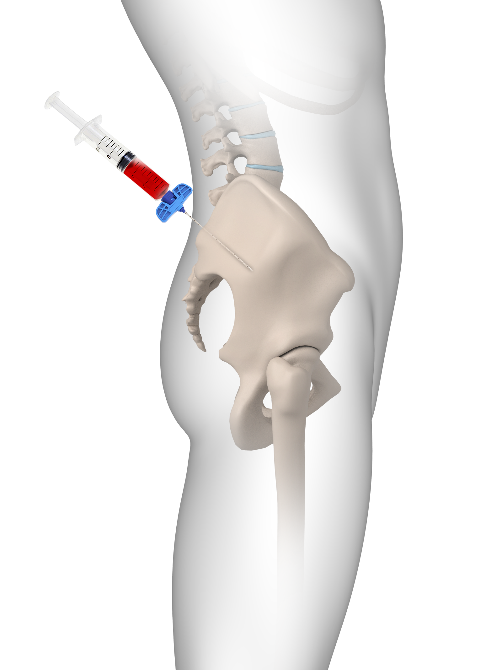 Bone Marrow Aspirate Concentrate (BMAC)