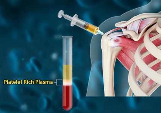 Platelet Rich Plasma