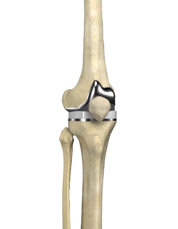 Mako Robotic-Arm Assisted Technology for total knee replacement