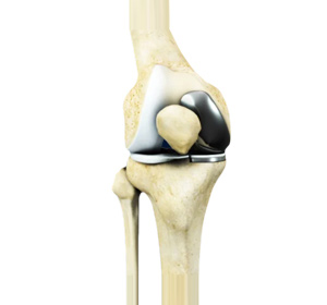 Robotic Unicondylar Knee Replacement