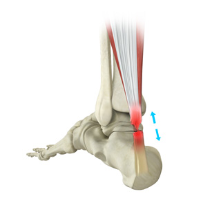 Achilles Tendon Rupture pic
