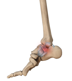 Ankle Sprain pic
