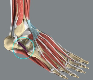 Ankle Tendonitis pic