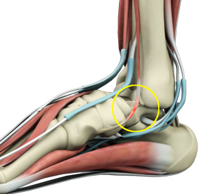 Anterior Tibial Tendon pic