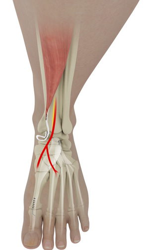 Anterior Tibialis Tendon Repair pic