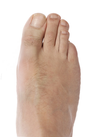 Brachymetatarsia pic