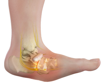 Charcot Foot and Ankle pic