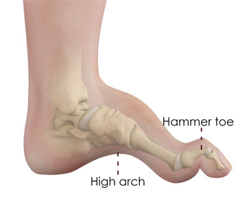 Charcot Marie Tooth pic
