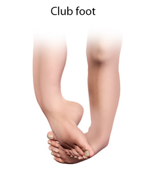 Clubfoot pic