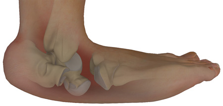 Diabetic Foot Care pic