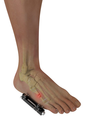 External Fixation for Foot and Ankle Trauma pic
