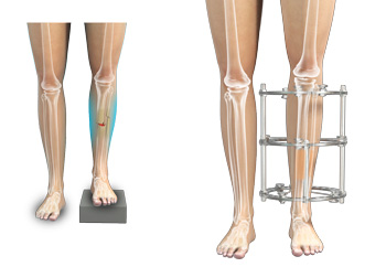 External Fixation pic