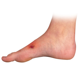 Cancer of the Foot and Leg pic