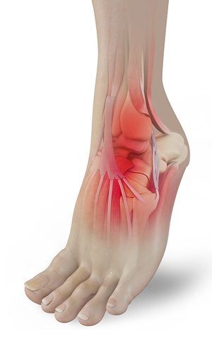Osteomyelitis pic