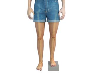 Lower Limb lengthening pic