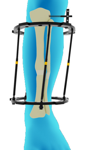 Lower Limb Deformity Correction pic