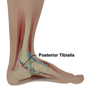 Posterior Tibialis Tendon Repair pic