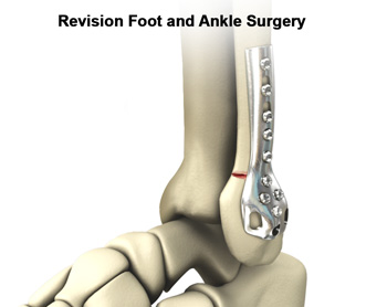 Revision Surgery pic