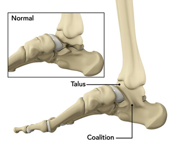 Tarsal Coalition pic