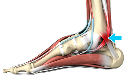 Tarsal Tunnel Syndrome pic