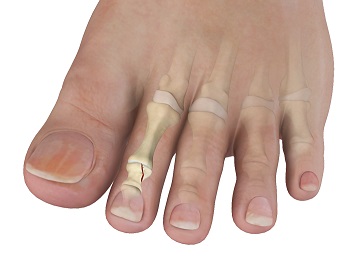 Toe Fractures pic
