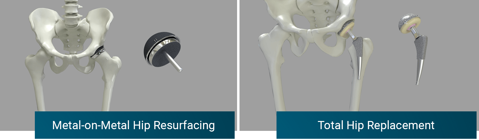 Picture of Why Choose Hip Resurfacing?