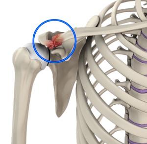 Acromioclavicular (AC) Joint Osteoarthritis pic