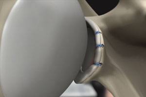 Anterior Shoulder Stabilization pic