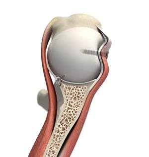 Arthroscopic Remplissage pic