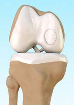 Autologous Chondrocyte Implantation pic