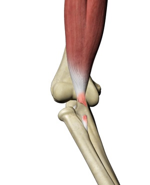 Biceps Tendon Repair pic