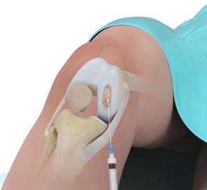 BioCartilage Regeneration pic