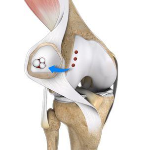 Cartilage Restoration of the Patellofemoral Joint pic