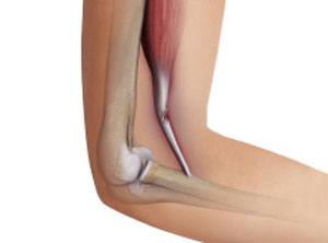 Distal Biceps Injuries pic