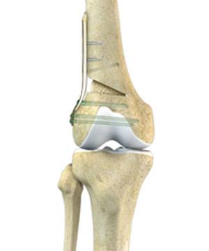 Distal Femoral Osteotomy pic