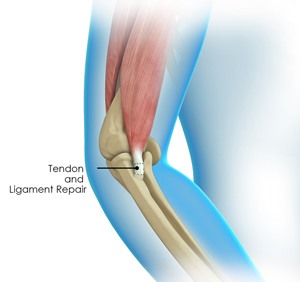 Elbow Tendon and Ligament Repair pic