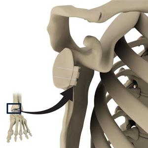 Glenoid Reconstruction pic