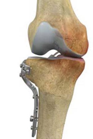 High Tibial Osteotomy pic