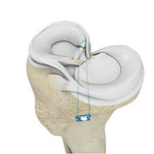 Meniscus Root Repair pic