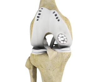 Osteochondral Autograft pic