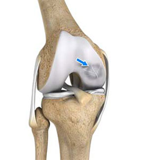 Osteochondritis Dissecans of the Knee pic