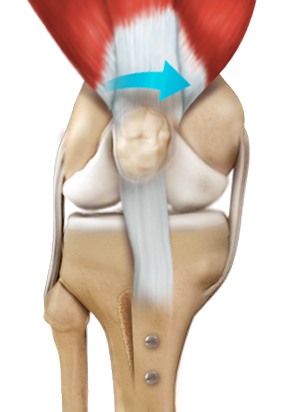 Patella Stabilization pic
