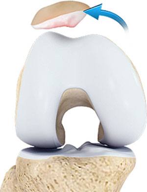 Patellar Instability pic