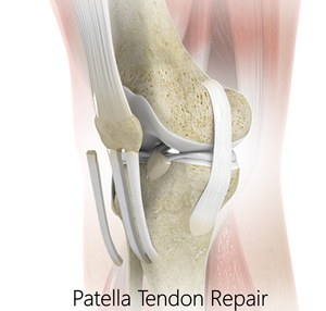 Patellar Tendon Repair pic