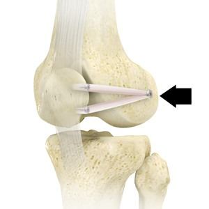 Patellofemoral Stabilization pic